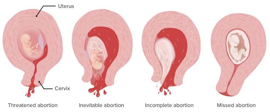 أنواع الإجهاض Abotion